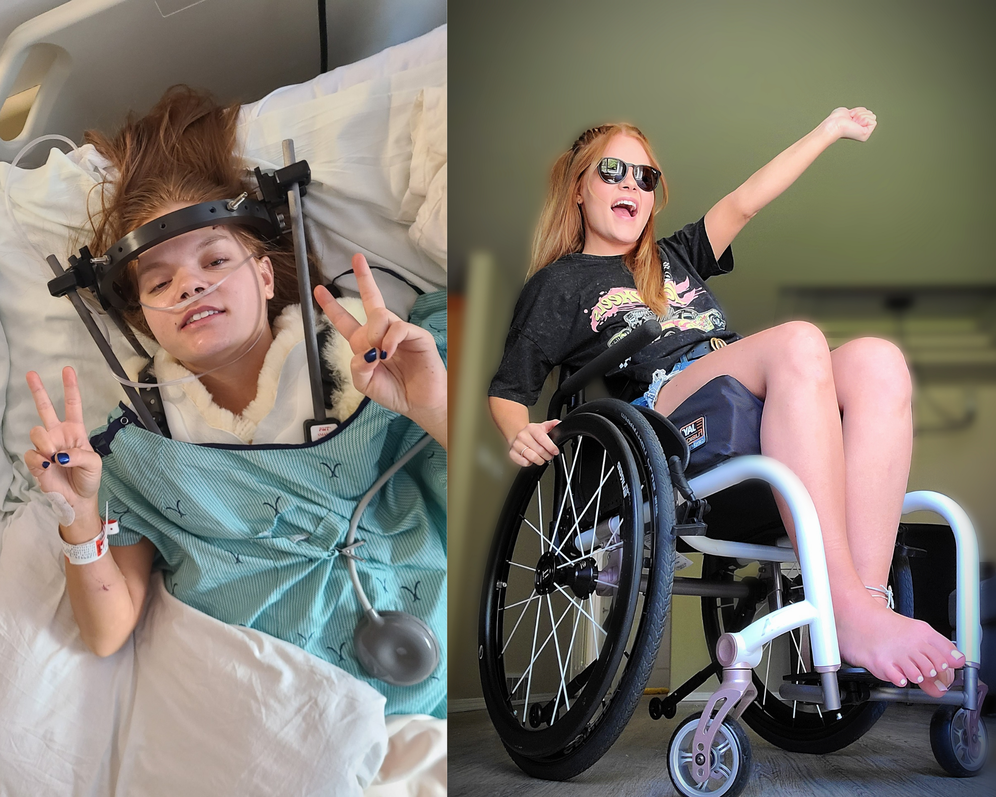 Motion Client Ambassador Brianna Seewald split across two photos. On left in hospital bed with halo holding up peace signs and on right smiling with left arm up and sitting in manual wheelchair
